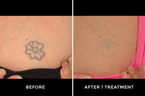 Laser Tattoo Removal in Malaysia- Price, Side Effects, Aftercare and More