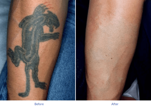 How Much Tattoo Removal Cost - TATTOOS