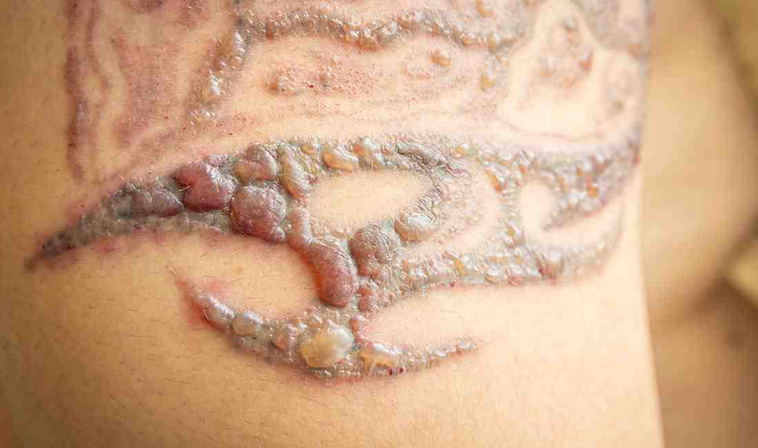 What are the side effects of tattoo?